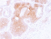 IHC testing of FFPE human prostate carcinoma with CD44v3 antibody (clone CD44V6/2496). Required HIER: steam sections in pH 9 10mM Tris with 1mM EDTA buffer for 10-20 min and allow to cool before testing.