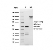 IHC testing of FFPE human prostate carcinoma with CD44v3 antibody (clone CD44V6/2496). Required HIER: steam sections in pH 9 10mM Tris with 1mM EDTA buffer for 10-20 min and allow to cool before testing.