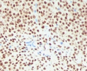 IHC staining of FFPE human melanoma tissue with recombinant SOX10 antibody (clone SBX10-2R). Required HIER: boil sections in pH 9 10mM Tris with 1mM EDTA for 10-20 minutes, followed by cooling at RT for 20 minutes, prior to staining.