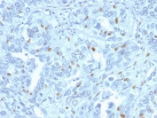 IHC testing of FFPE human endometrial carcinoma with Cyclin A2 antibody. Required HIER: steam section in pH6 citrate buffer for 20 min and allow to cool prior to staining.