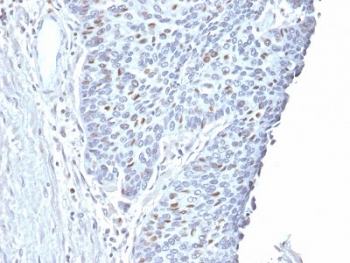 IHC testing of FFPE human endometrial carcinoma with Cyclin A2 antibody. Required HIER: steam section in pH6 citrate buffer for 20 min and allow to cool prior to staining.~