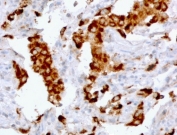IHC staining of FFPE human lung adenocarcinoma with recombinant Napsin A antibody (clone NPSNA-2R). Required HIER: boil tissue sections in pH 9 10mM Tris with 1mM EDTA for 10-20 min followed by cooling at RT for 20 min.