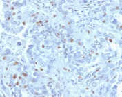 IHC testing of FFPE human endometrial carcinoma with CCNA2 antibody (clone CNA2-1). Required HIER: steam section in pH6 citrate buffer for 20 min and allow to cool prior to staining.