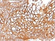 IHC staining of FFPE human basal cell carcinoma with CD9 antibody (clone CD9/1619). HIER: boil tissue sections in pH6, 10mM citrate buffer, for 10-20 min followed by cooling at RT for 20 min.