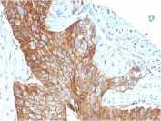 IHC staining of FFPE human cervical carcinoma with CD9 antibody (clone CD9/1619). HIER: boil tissue sections in pH6, 10mM citrate buffer, for 10-20 min followed by cooling at RT for 20 min.