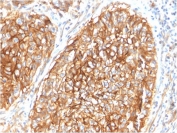 IHC staining of FFPE human lung carcinoma with CD9 antibody (clone CD9/1619). HIER: boil tissue sections in pH6, 10mM citrate buffer, for 10-20 min followed by cooling at RT for 20 min.