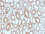 IHC testing of FFPE human renal cell carcinoma with Calnexin antibody (clone CANX/1543). HIER: boil tissue sections in pH6, 10mM citrate buffer, for 10-20 min followed by cooling at RT for 20 min. 