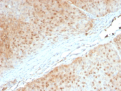AKT1 Antibody Pancreas Tissue IHC. Immunohistochemistry of FFPE human pancreas tissue using AKT1 antibody shows widespread HRP-DAB brown cytoplasmic and nuclear staining in pancreatic epithelial cells, consistent with active PI3K-AKT signaling, while stromal regions display comparatively lighter staining; detection was performed with clone AKT1/2552.