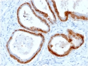 IHC testing of FFPE human prostate cancer with recombinant Basic Cytokeratin antibody (clone KRTH/2147R). Required HIER: boil tissue sections in 10mM citrate buffer, pH 6, for 10-20 min followed by cooling at RT for 20 min.