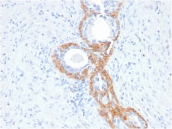 IHC testing of FFPE human prostate cancer with recombinant Basic Cytokeratin antibody (clone rKRTH/2148). Required HIER: boil tissue sections in 10mM citrate buffer, pH 6, for 10-20 min followed by cooling at RT for 20 min.~