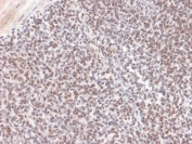 IHC testing of FFPE Ewing's Sarcoma with ALK antibody (clone ALK/1504). HIER: boil tissue sections in pH6, 10mM citrate buffer, for 10-20 min followed by cooling at RT for 20 min.