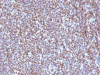 IHC testing of FFPE anaplastic large-cell lymphoma with ALK antibody (clone ALK/1504). HIER: boil tissue sections in pH6, 10mM citrate buffer, for 10-20 min followed by cooling at RT for 20 min.~