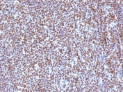 IHC testing of FFPE anaplastic large-cell lymphoma with ALK antibody (clone ALK/1504). HIER: boil tissue sections in pH6, 10mM citrate buffer, for 10-20 min followed by cooling at RT for 20 min.