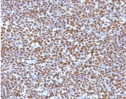 IHC testing of FFPE anaplastic large-cell lymphoma with ALK antibody (clone ATKR-1). HIER: boil tissue sections in pH6, 10mM citrate buffer, for 10-20 min followed by cooling at RT for 20 min.