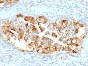 IHC testing of FFPE human endometrial carcinoma with Mesothelin antibody (clone MSLN/2131). HIER: boil tissue sections in pH 9 10mM Tris with 1mM EDTA for 10-20 min followed by cooling at RT for 20 min.
