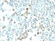 IHC staining of FFPE human lung with biotinylated Mesothelin antibody (clone MSLN/2131). HIER: boil tissue sections in pH 9 10mM Tris with 1mM EDTA for 20 min and allow to cool before testing.