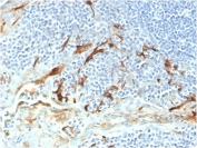 IHC staining of FFPE human endometrial carcinoma with biotinylated Mesothelin antibody (clone MSLN/2131). HIER: boil tissue sections in pH 9 10mM Tris with 1mM EDTA for 20 min and allow to cool before testing.