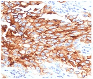 IHC testing of FFPE human lung mesothelioma with MSLN antibody (clone MKPF-1). HIER: boil tissue sections in pH 9 10mM Tris with 1mM EDTA for 10-20 min followed by cooling at RT for 20 min.~