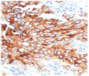 IHC testing of FFPE human lung mesothelioma with MSLN antibody (clone MKPF-1). HIER: boil tissue sections in pH 9 10mM Tris with 1mM EDTA for 10-20 min followed by cooling at RT for 20 min.