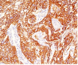 IHC testing of FFPE human lung squamous cell carcinoma with EGFR antibody (clone ERB68-1). Required HIER: boiling tissue sections in pH 9 10mM Tris with 1mM EDTA for 10-20 min.