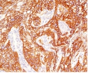 IHC testing of FFPE human lung squamous cell carcinoma with EGFR antibody (clone ERB68-1). Required HIER: boiling tissue sections in pH 9 10mM Tris with 1mM EDTA for 10-20 min.