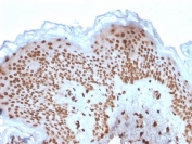 IHC testing of FFPE human basal cell carcinoma with Emerin antibody (clone EMD/2167). Required HIER: boiling tissue sections in 10mM citrate buffer, pH 6, for 10-20 min and allow to cool prior to staining.