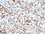 IHC testing of FFPE human renal cell carcinoma with Emerin antibody (clone EMD/2167). Required HIER: boiling tissue sections in 10mM citrate buffer, pH 6, for 10-20 min and allow to cool prior to staining.