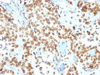 IHC testing of FFPE human breast carcinoma with Emerin antibody (clone EMD/2167). Required HIER: boiling tissue sections in 10mM citrate buffer, pH 6, for 10-20 min and allow to cool prior to staining.