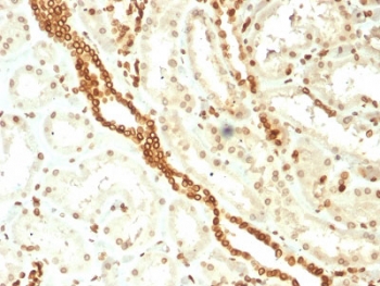 IHC testing of FFPE human renal cell carcinoma with Emerin antibody (clone EMD/2168). Required HIER: boiling tissue sections in 10mM citrate buffer, pH 6, for 10-20 min and allow to cool prior to staining.