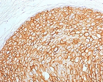 IHC testing of FFPE human breast carcinoma with ErbB2 antibody (clone 2KRI7-2). HIER: boil tissue sections in pH6, 10mM citrate buffer, for 10-20 min followed by cooling at RT for 20 min.