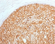 IHC testing of FFPE human breast carcinoma with ErbB2 antibody (clone 2KRI7-2). HIER: boil tissue sections in pH6, 10mM citrate buffer, for 10-20 min followed by cooling at RT for 20 min.