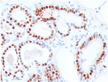 IHC testing of human breast carcinoma stained with ER alpha antibody (clone NR3Ga-2). Staining of forma