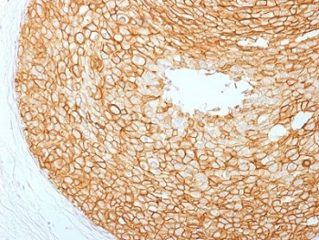 IHC testing of FFPE human breast carcinoma with HER2 antibody. HIER: boil tissue sections in pH6, 10mM citrate buffer, for 10-20 min followed by cooling at RT for 20 min.~
