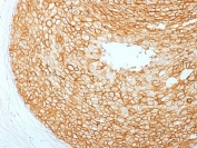 IHC testing of FFPE human breast carcinoma with HER2 antibody. HIER: boil tissue sections in pH6, 10mM citrate buffer, for 10-20 min followed by cooling at RT for 20 min.