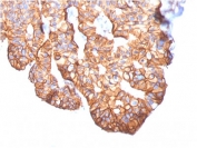 IHC testing of FFPE human breast carcinoma with HER2 antibody. HIER: boil tissue sections in pH6, 10mM citrate buffer, for 10-20 min followed by cooling at RT for 20 min.