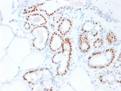 IHC testing of human breast carcinoma stained with Estrogen Receptor alpha antibody (clone ESR1/1935). Staining of formalin-fixed tissues requires boiling tissue sections in pH 9 10mM Tris with 1mM EDTA for 10-20 min followed by cooling at RT for 20 minutes.