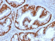IHC testing of human endometrial carcinoma stained with Estrogen Receptor alpha antibody (clone ESR1/1935). Staining of formalin-fixed tissues requires boiling tissue sections in pH 9 10mM Tris with 1mM EDTA for 10-20 min followed by cooling at RT for 20 minutes.