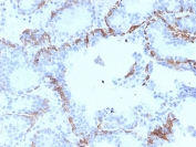 IHC testing of FFPE human prostate cancer with Cytokeratin 6 antibody (clone KRT6A/2368). Required HIER: boil tissue sections in pH6, 10mM citrate buffer, for 10-20 min followed by cooling at RT for 20 min.