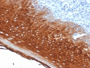 IHC testing of FFPE human basal cell carcinoma with Cytokeratin 6 antibody (clone KRT6A/2368). Required HIER: boil tissue sections in pH6, 10mM citrate buffer, for 10-20 min followed by cooling at RT for 20 min.