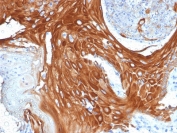 IHC testing of FFPE human basal cell carcinoma with Cytokeratin 6 antibody (clone KRT6A/2368). Required HIER: boil tissue sections in pH6, 10mM citrate buffer, for 10-20 min followed by cooling at RT for 20 min.