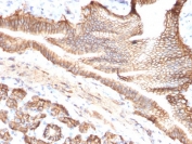 IHC testing of FFPE human pancreatic carcinoma with TROP2 antibody (clone TACSTD2/2151). Required HIER: boil tissue sections in pH 9 10mM Tris with 1mM EDTA for 10-20 min followed by cooling at RT for 20 min.