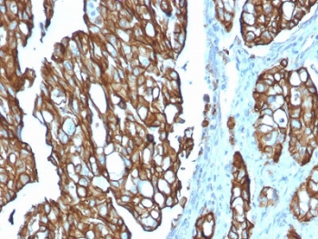 IHC testing of FFPE human colon carcinoma with TROP2 antibody (clone TACSTD2/2151). Required HIER: boil tissue sections in pH 9 10mM Tris with 1mM EDTA for 10-20 min followed by cooling at RT for 20 min.
