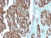 IHC testing of FFPE human colon carcinoma with TROP2 antibody (clone TACSTD2/2151). Required HIER: boil tissue sections in pH 9 10mM Tris with 1mM EDTA for 10-20 min followed by cooling at RT for 20 min.