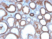 IHC testing of FFPE human colon carcinoma with biotinylated TROP2 antibody (clone TACSTD2/2151). Required HIER: boil tissue sections in pH 9 10mM Tris with 1mM EDTA for 10-20 min followed by cooling at RT for 20 min.