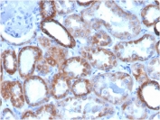 IHC testing of FFPE human pancreatic carcinoma with biotinylated TROP2 antibody (clone TACSTD2/2151). Required HIER: boil tissue sections in pH 9 10mM Tris with 1mM EDTA for 10-20 min followed by cooling at RT for 20 min.