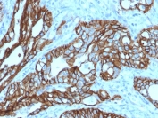 IHC testing of FFPE human colon carcinoma with TROP2 antibody (clone TACSTD2/2152). Required HIER: boil tissue sections in pH6, 10mM citrate buffer, for 10-20 min followed by cooling at RT for 20 min.