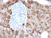 IHC testing of FFPE human pancreatic carcinoma with TROP2 antibody (clone TACSTD2/2152). Required HIER: boil tissue sections in pH 9 10mM Tris with 1mM EDTA for 10-20 min followed by cooling at RT for 20 min.