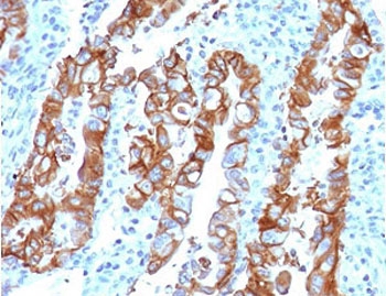IHC testing of FFPE human colon carcinoma with TROP2 antibody (clone TCSR2-1). Required HIER: boil tissue sections in pH 9 10mM Tris with 1mM EDTA for 10-20 min followed by cooling at RT for 20 min.~