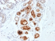 IHC testing of FFPE human breast carcinoma stained with Mammaglobin antibody (MGB/2000). Required HIER: boiling tissue sections in 10mM citrate buffer, pH6, for 10-20 min followed by cooling at RT for 20 min.