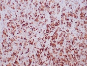 IHC testing of FFPE human breast adenocarcinoma stained with Mammaglobin antibody (MGB/2000). Required HIER: boil tissue sections in pH 9 10mM Tris with 1mM EDTA for 20 min and allow to cool before testing.